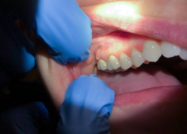 Best Emergency Care for Gum Disease in Watford City, ND